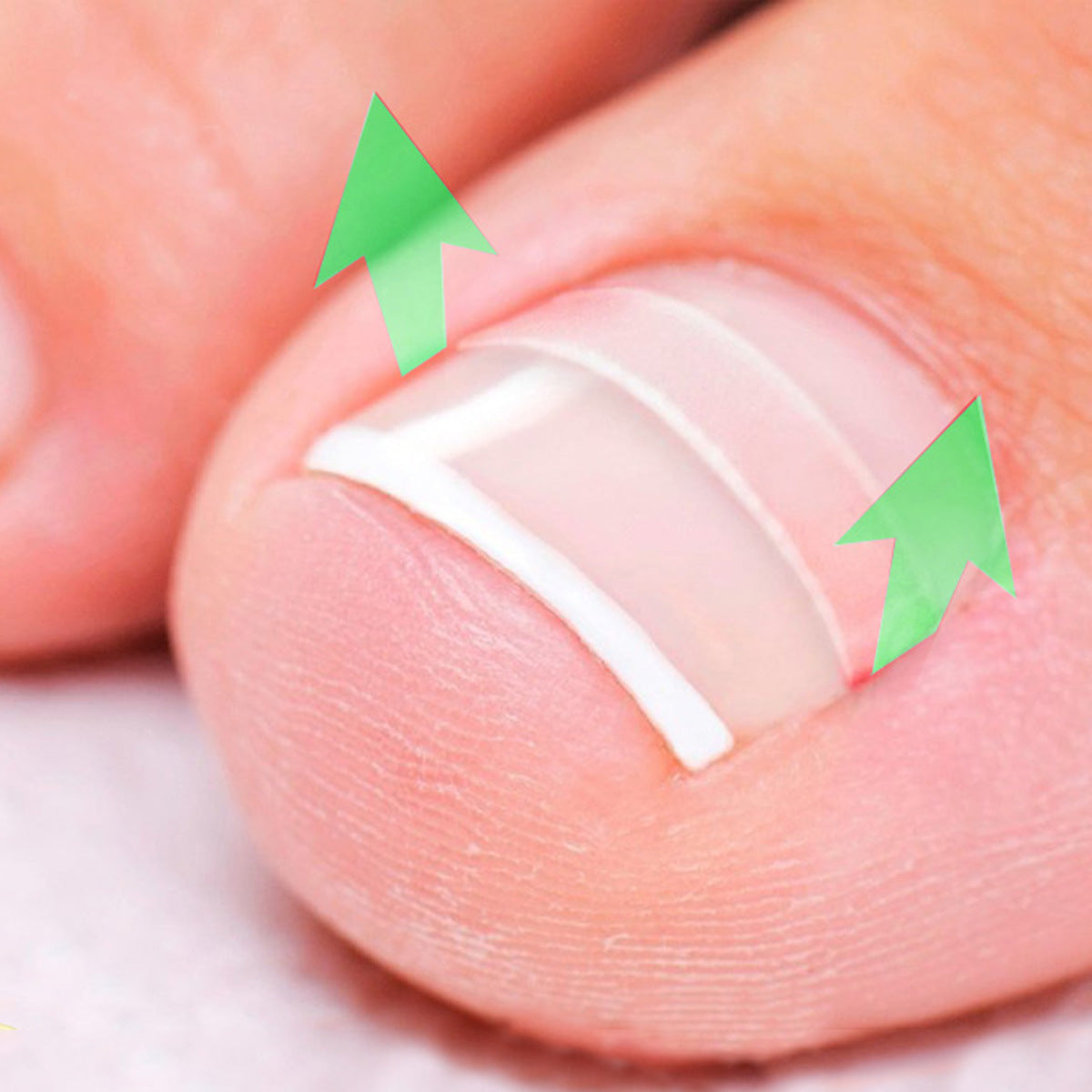 10-Piece Ingrown Toenail Correction Sticker Set