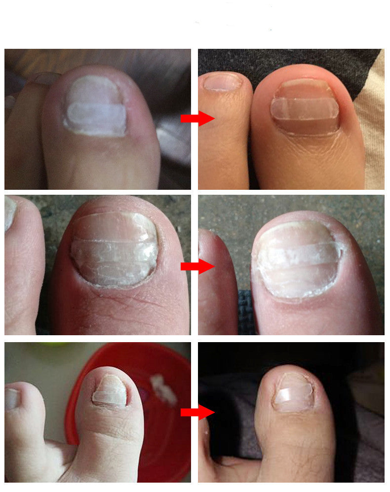 10-Piece Ingrown Toenail Correction Sticker Set