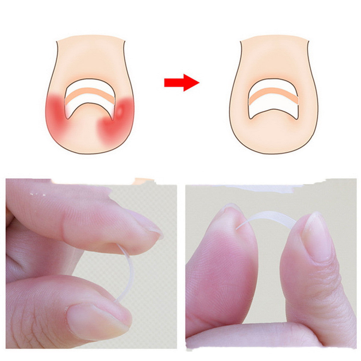 10-Piece Ingrown Toenail Correction Sticker Set